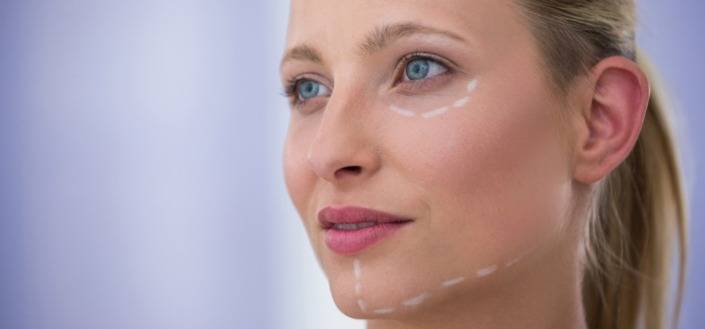 Woman with marks drawn for cosmetic treatment