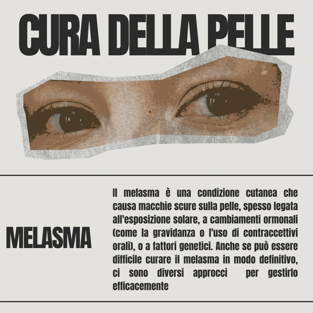 Melasma