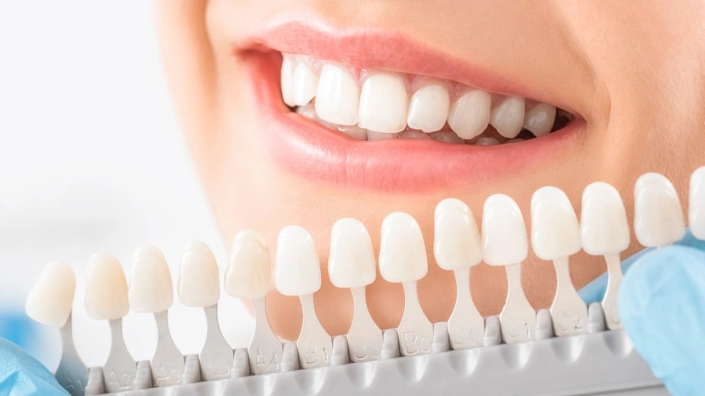 faccette-dentali Faccette dentali