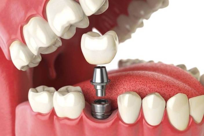 impianto-dentale implantologia dentale