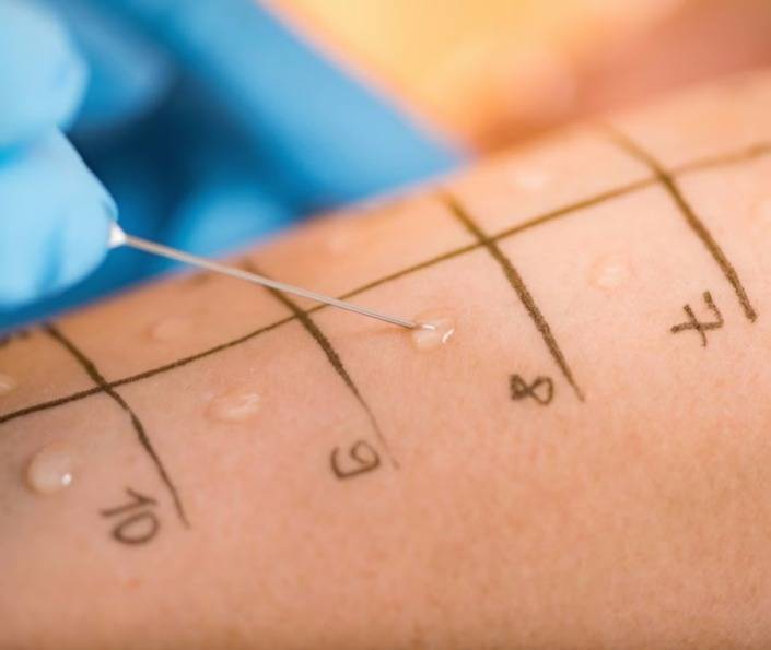 prick-test Prick test