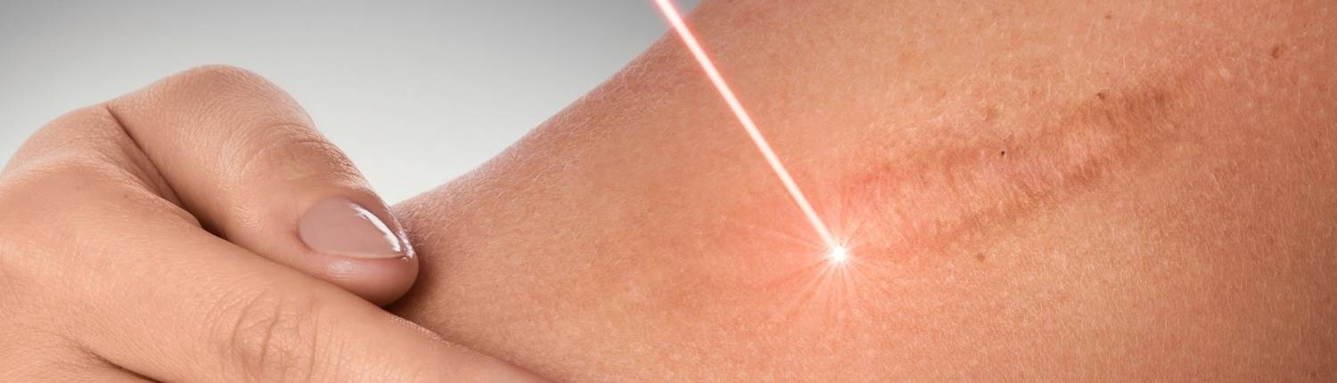 Trattamento-laser-cicatrici Trattamento delle cicatrici