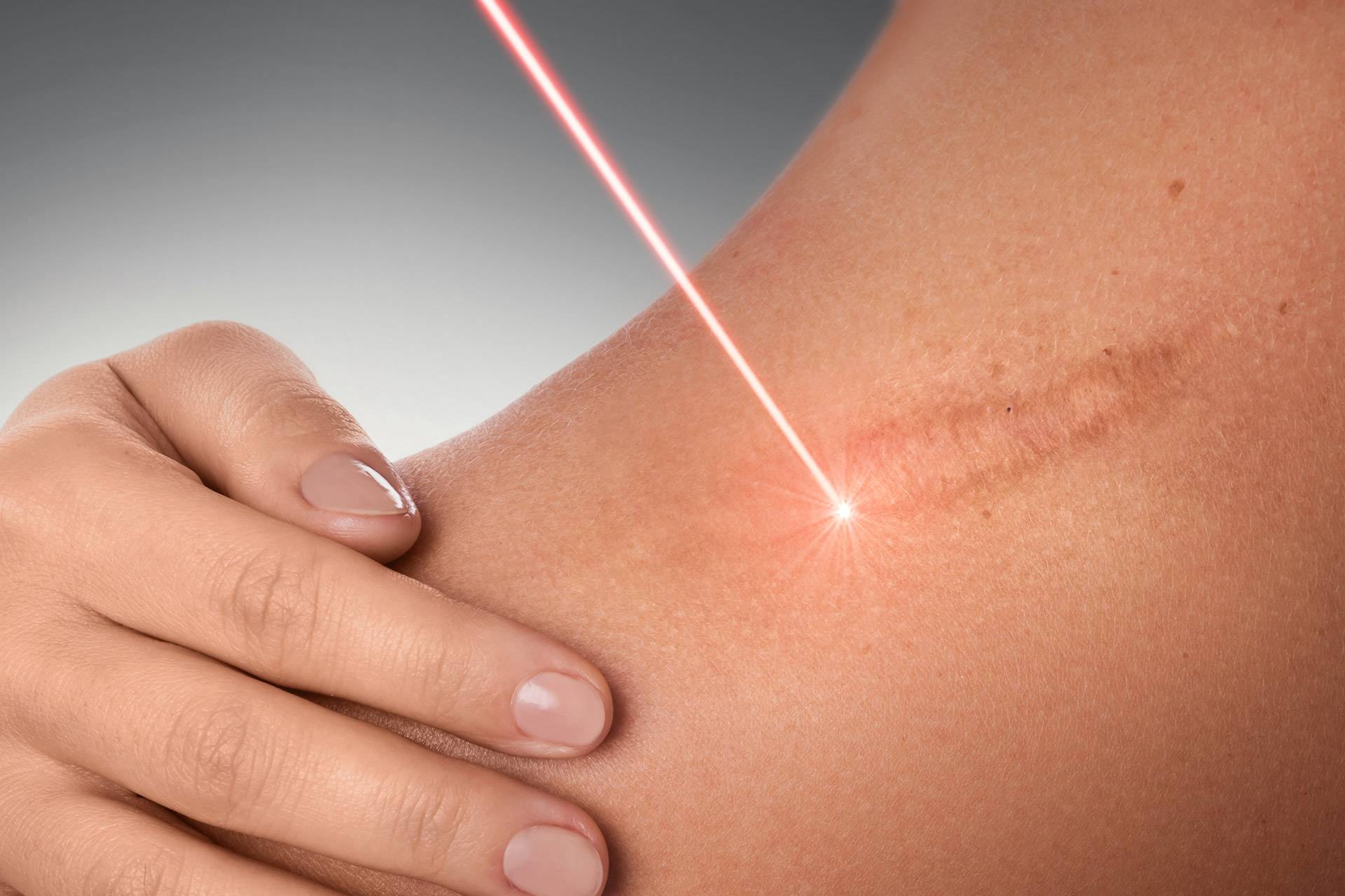 Trattamento-laser-cicatrici Trattamento delle cicatrici