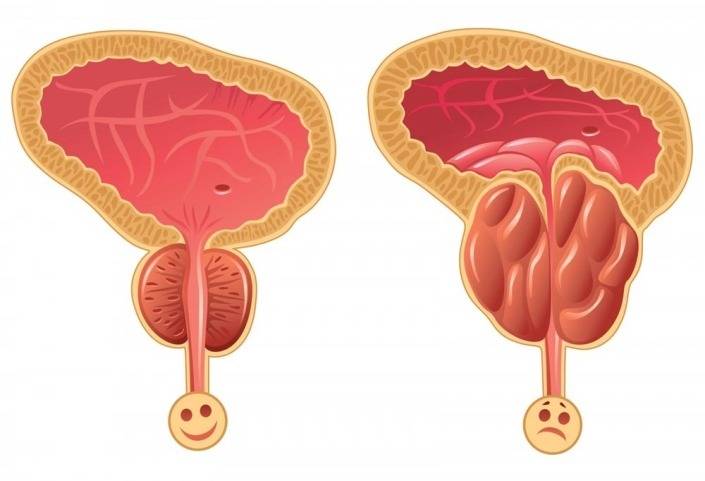 iperplasia-prostatica-benigna-sintomi Iperplasia prostatica benigna