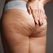 cellulite