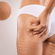 Come Combattere la Cellulite con la Medicina Estetica: Trattamenti Efficaci e Iniezioni di Ozono