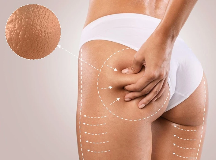 cellulite