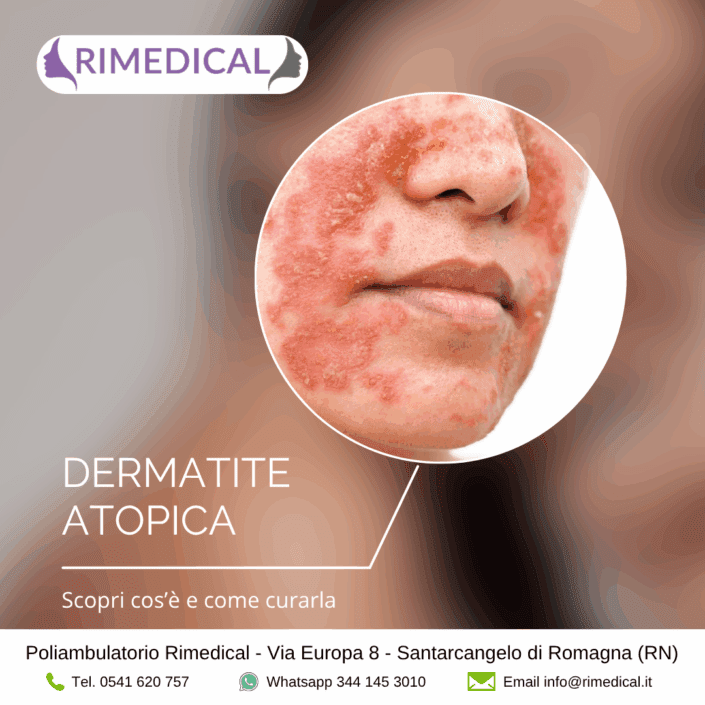 dermatite-atopica