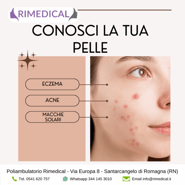 eczema-acne-macchie