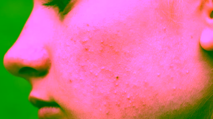 acne-rimini