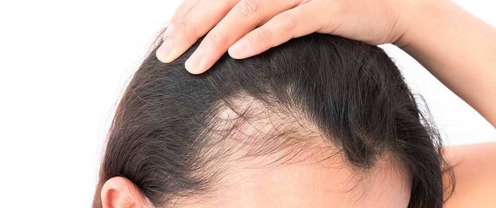 perdita-capelli-alopecia-rimini