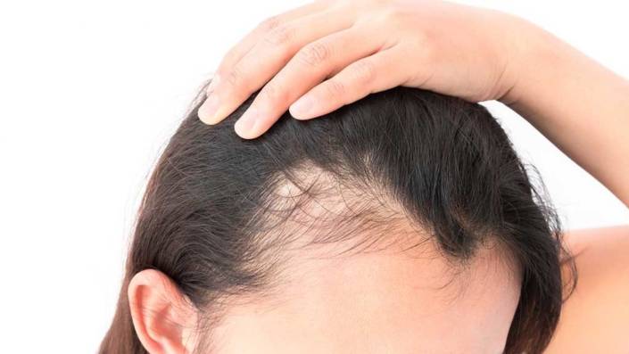 perdita-capelli-alopecia-rimini