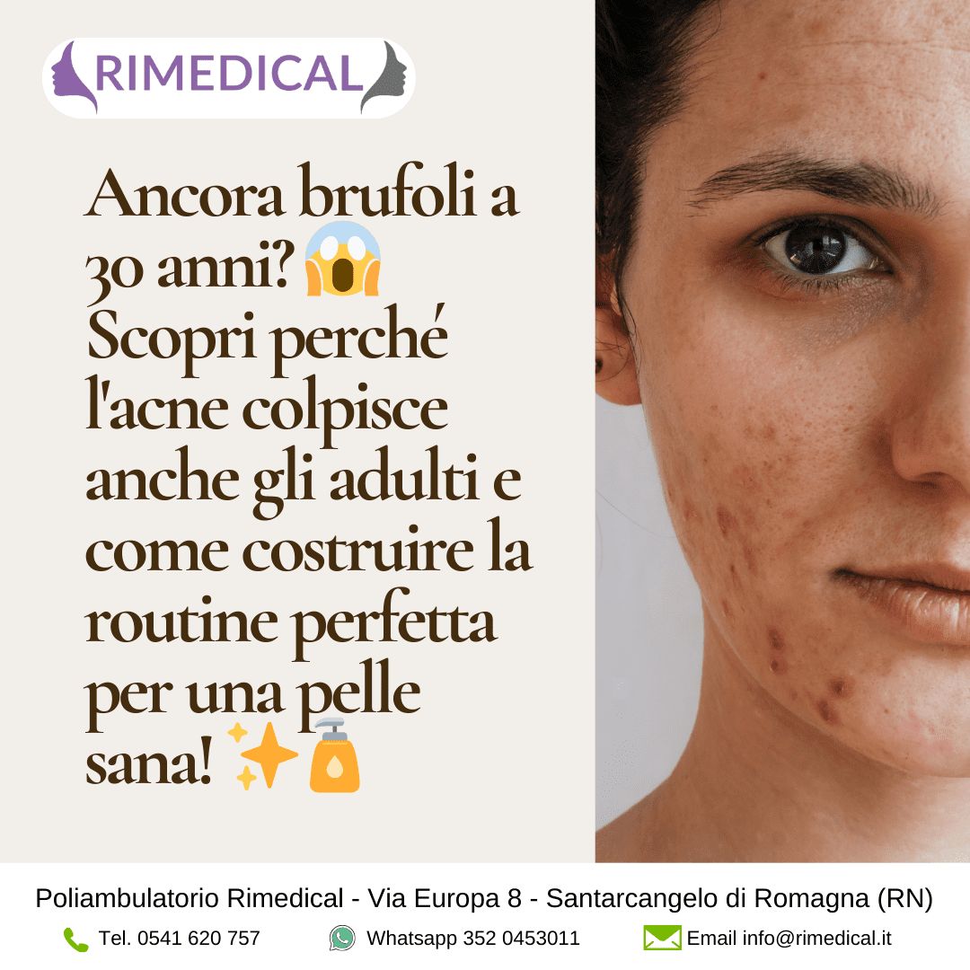 curare-acne