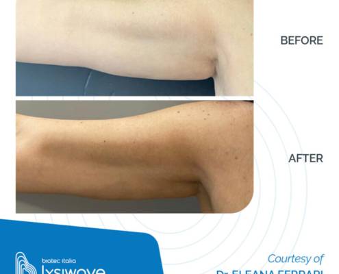 LYSIWAVE_Before-After_16-800x800