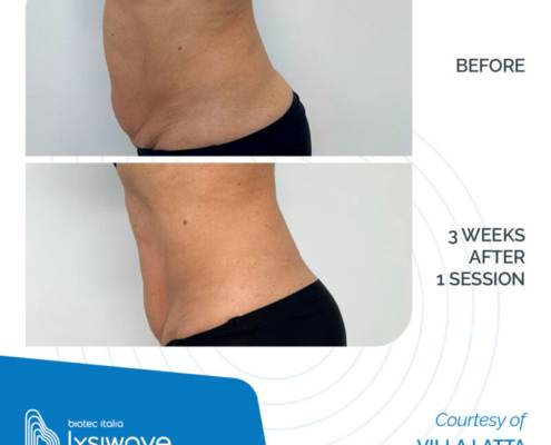 LYSIWAVE_Before-After_17-800x800