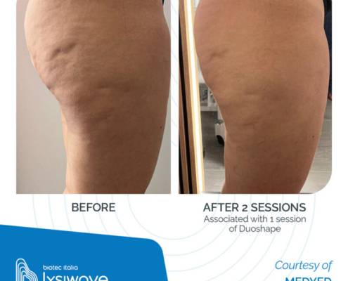 LYSIWAVE_Before-After_20-800x800