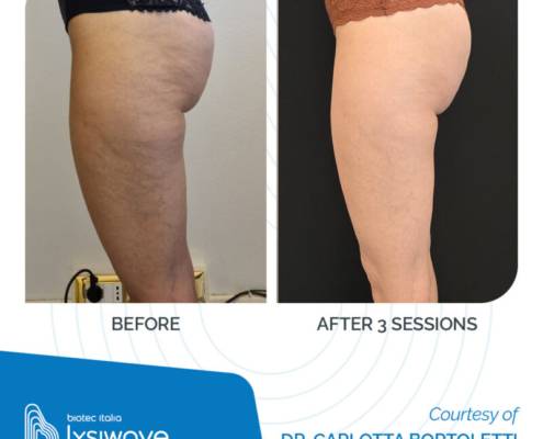 LYSIWAVE_Before-After_33-800x800