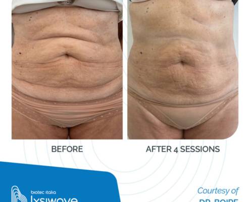LYSIWAVE_Before-After_37-800x800