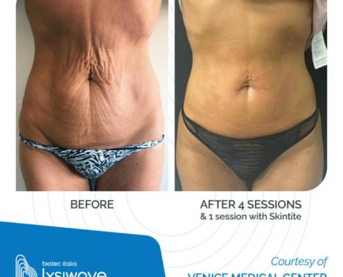 LYSIWAVE_Before-After_58-800x800